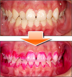 赤色がついている個所が歯の汚れです